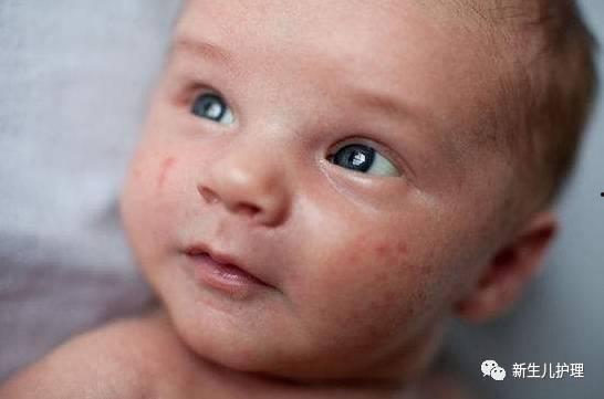 吃小瓜会不会过敏,了解过敏源，守护健康生活